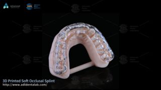 Bruxism Comfort를 위한 맞춤형 3D 프린팅 부목