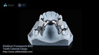 Vitallium Framework 내추럴 에스테틱 Easy Fit