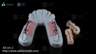 All On X Dentistry를 위한 프리미엄 티타늄 임플란트 바