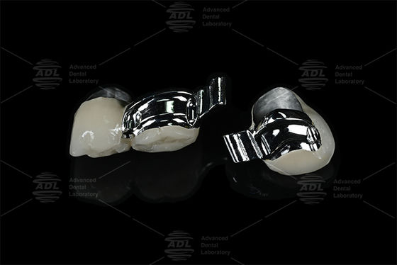 주문 중국 치과 기공소 조절 가능한 환자 맞춤형 키웨이 정밀 어태치먼트 (PFM) 온라인 제조