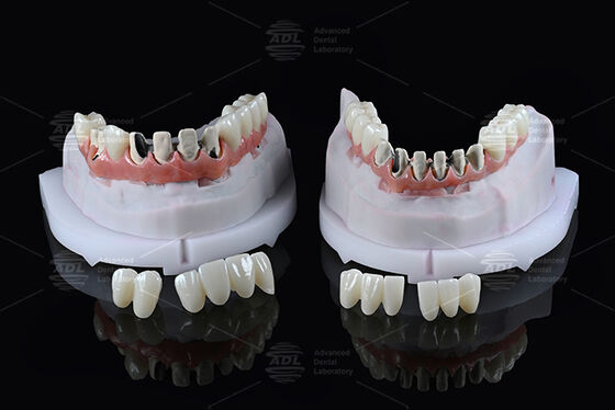 주문 중국 치과 연구실 타이탄 풀 아치 하이브리드 브리지 즉시 로딩 A1 Shade Malong 디자인 나사 Cad/Cam 유지 온라인 제조